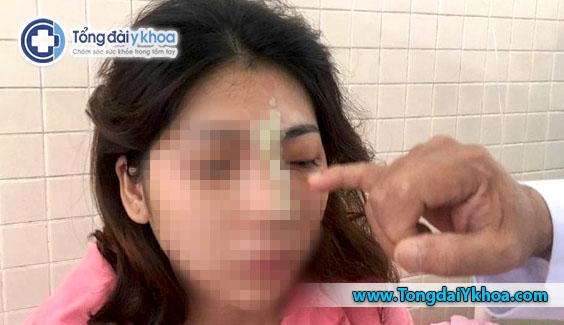 Bình Phước cô gái trẻ bị mù mắt sau khi tiêm filler nâng mũi tại spa