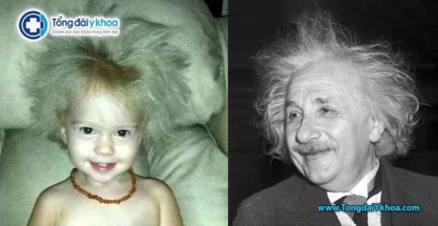 co be co mai toc choi rom Unruly Hair Due To Rare Genetic Condition Einstein